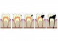 /album/dental-cavities/dental-cavity-1-jpg/
